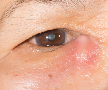 Orbit Oculoplastic and Lacrimal Surgery
