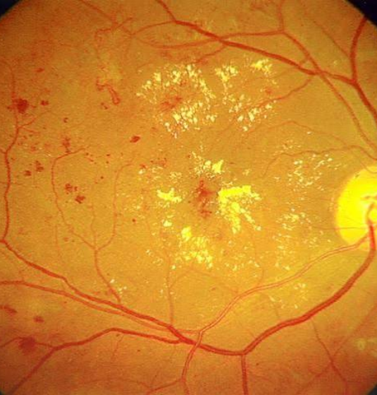 Vitreo-retina and Uvea Care